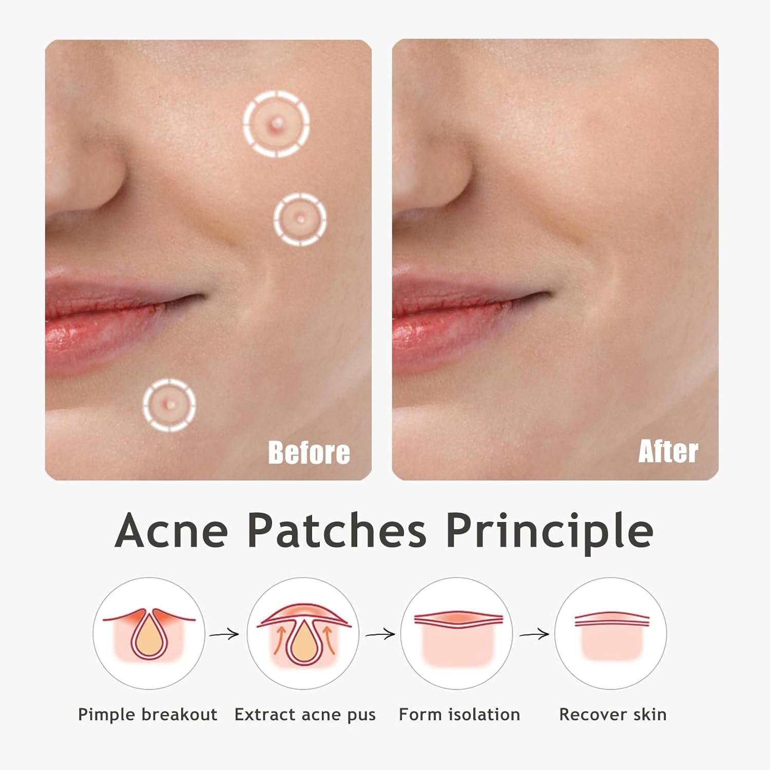 Ultra Pimple Patches - Hydrocolloid Acne Patch for Covering Zits and Blemishes Breakouts Spot Acne Dots Stickers for Face and Skin (48 Counts) Day and Night Use